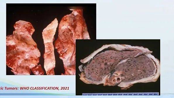 易小贷苹果版:【衡道丨笔记】2021版WHO胸膜间皮瘤更新要点及鉴别诊断-第6张图片-太平洋在线下载