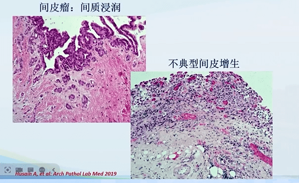 易小贷苹果版:【衡道丨笔记】2021版WHO胸膜间皮瘤更新要点及鉴别诊断-第16张图片-太平洋在线下载